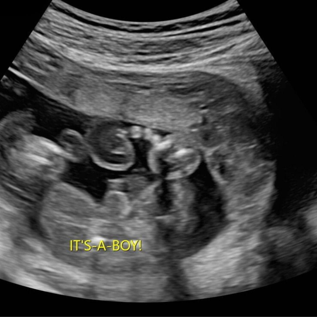 Anatomy Scan 3 - OBGYN Ultrasound CME Course Content
