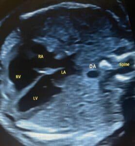Comparing Normal and Abnormal Findings in Three-Vessel Trachea View