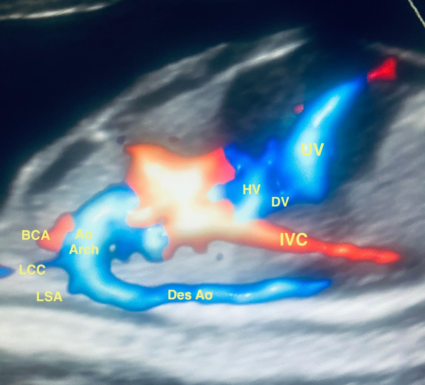 Clinical Doppler in Fetal Heart Imaging: Techniques and Interpretation