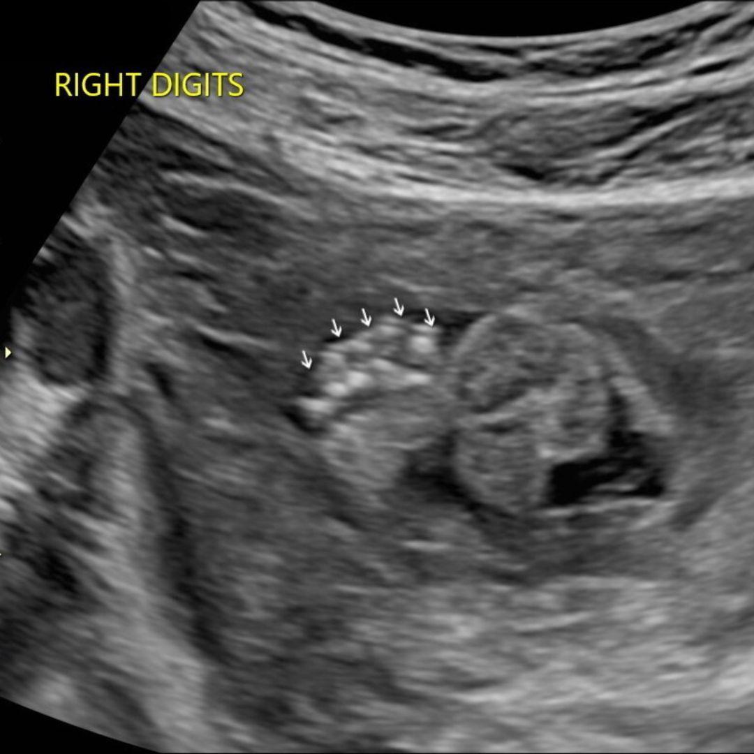 Anatomy Scan 1 - OBGYN Ultrasound CME Course Content