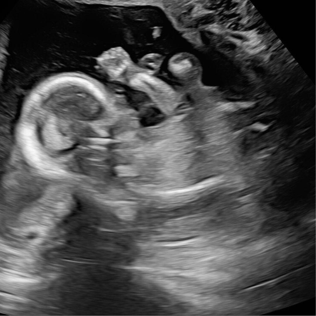Anatomy Scan 2 - OBGYN Ultrasound CME Course Content