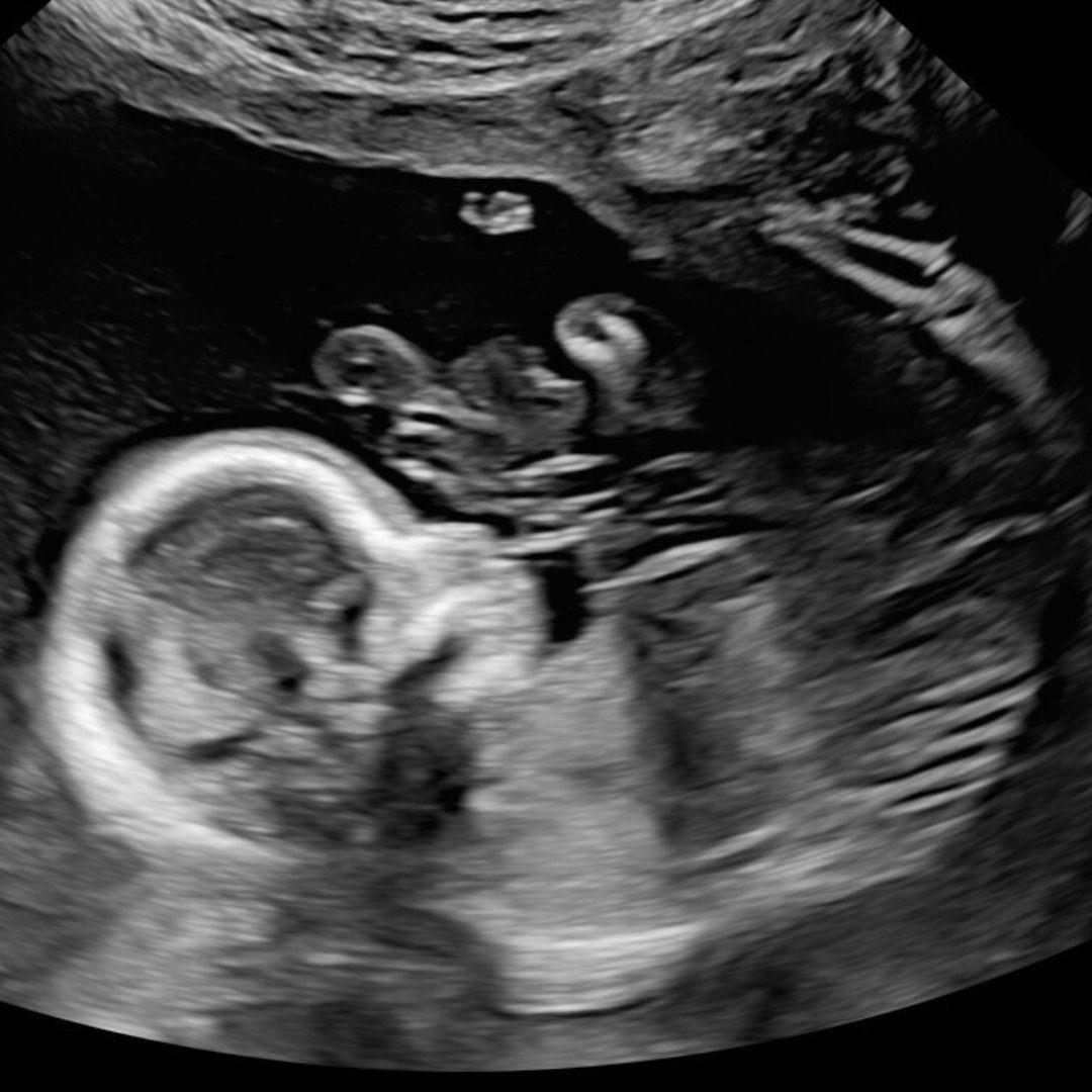 Anatomy Scan 4 - OBGYN Ultrasound CME Course Content
