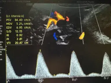 Uterine Artery Doppler First Trimester Pre-Eclampsia Screening