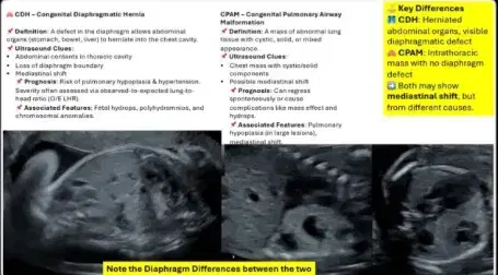 Pulmonary Airway Malformation