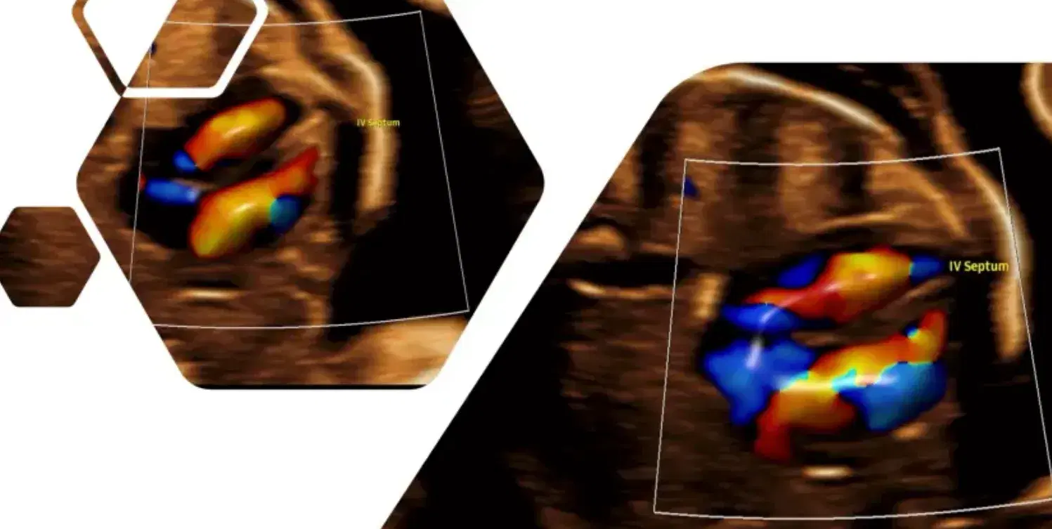 Fetal Cardiac Morphology: Understanding the Four Chambers and Normal Markers