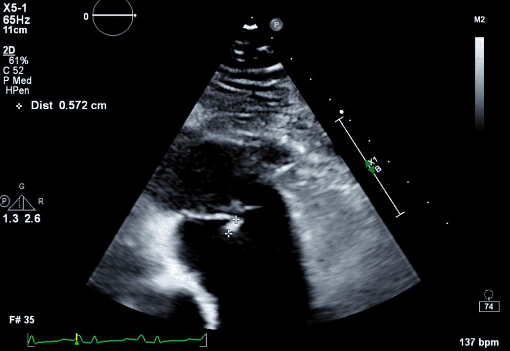 Infective Endocarditis