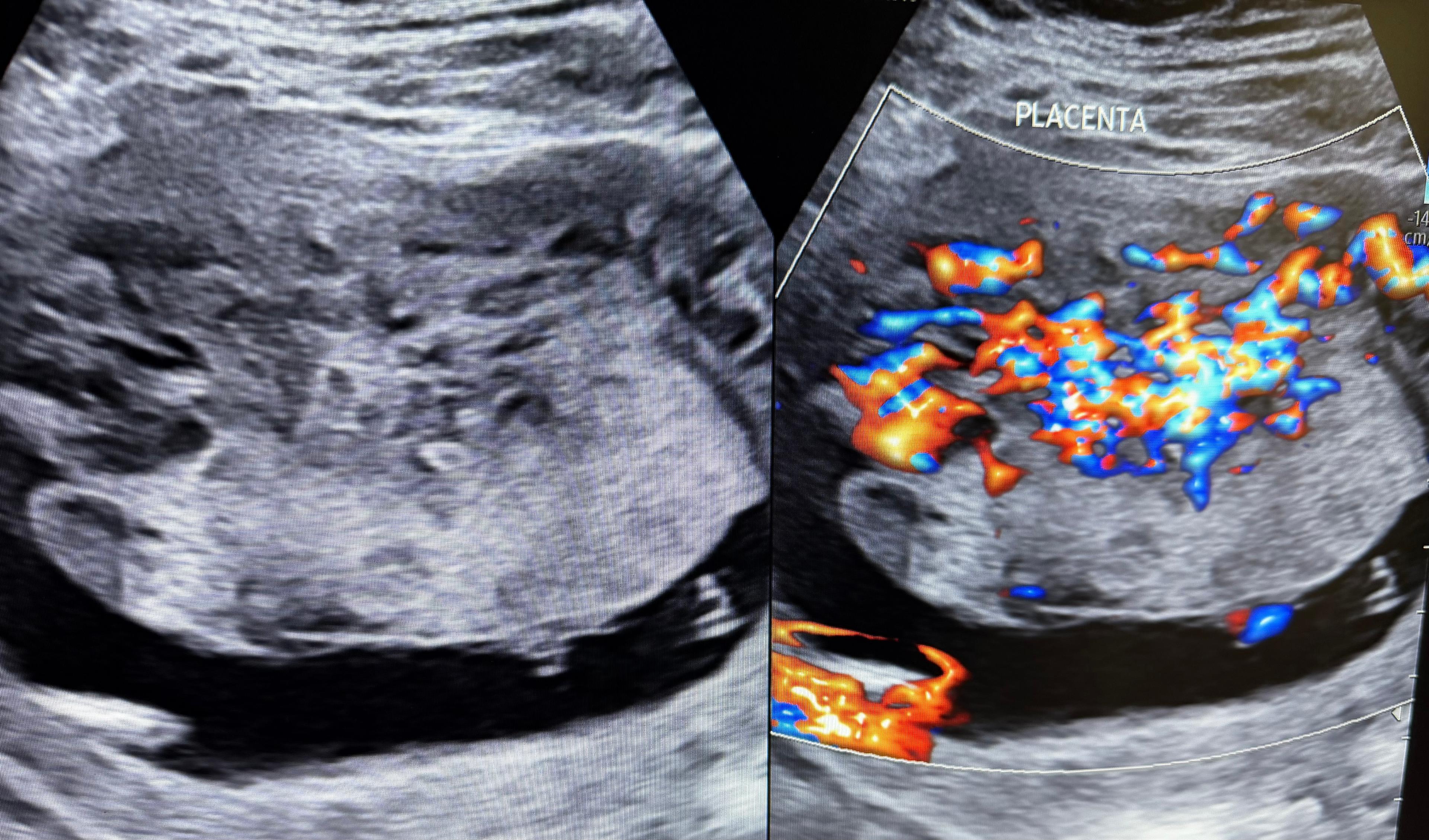 Placenta Accreta Spectrum (PAS): Early Recognition, Reporting, and Referral in Obstetric Imaging
