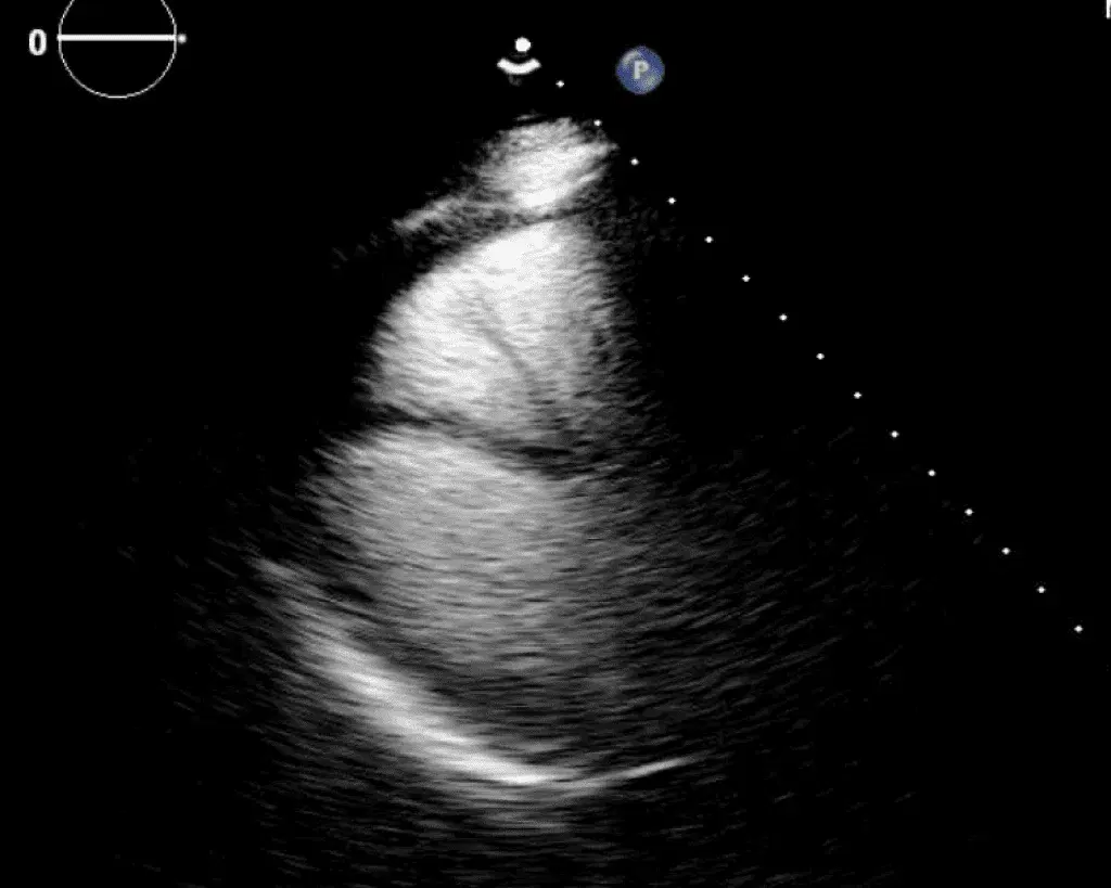 Contrast Enhanced Echocardiography