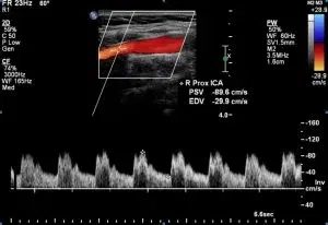 Carotid Ultrasound Case Series: What's the Diagnosis?