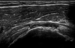 Ultrasound of the Shoulder Case Series:  What is the Diagnosis?
