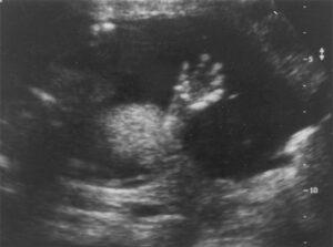 The Biophysical Profile Score