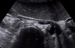 Renal Doppler Case Series