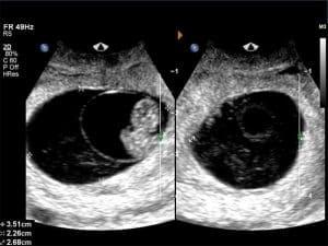 Sonographic Assessment of the Umbilical Cord