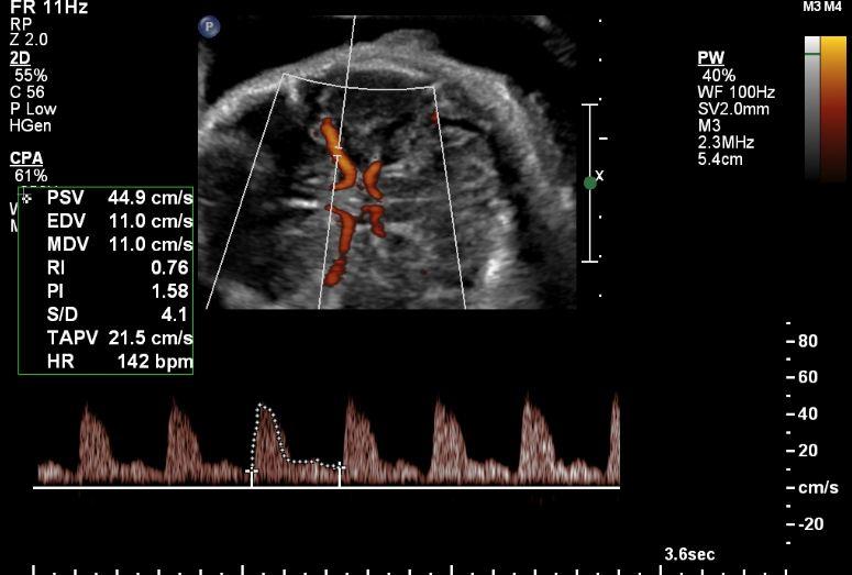 Multi-Vessel Doppler Studies in Intra-Uterine Growth Restriction