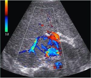 Liver Doppler Case Series