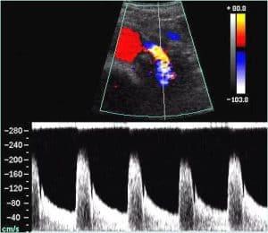 Duplex and Color Doppler of the Kidney
