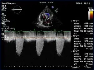 Case Studies in Rheumatic Heart Disease, Part 1