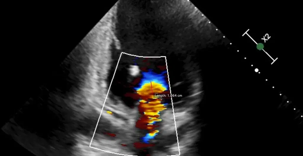 Case Studies: Secondary Mitral Regurgitation