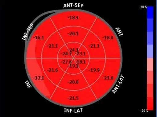 Case Studies in LV Systolic Function: Ischemic Dysfunction