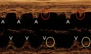 Case Studies: Fetal Arrhythmias
