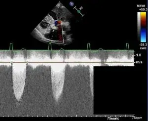 Case Studies: Aortic Stenosis