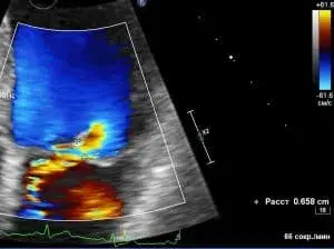 Case Studies: Primary Mitral Regurgitation