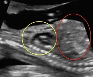 Case Studies: Fetal Skeletal Dysplasias