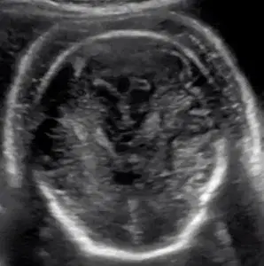 Case Studies:  Fetal Hydrops