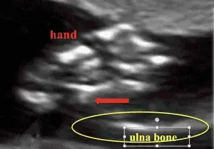 Case Studies: Fetal Extremities