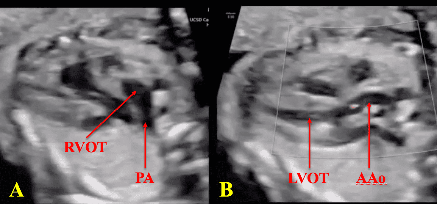 Fetal Cardiac Outflow Tracts: Normal and Abnormal Anatomy | IAME