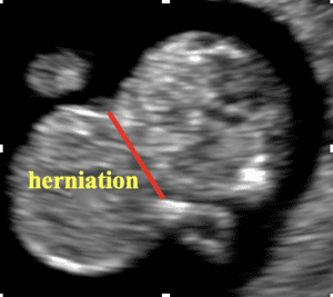 Abdominal Wall Defects, herniation, fetal