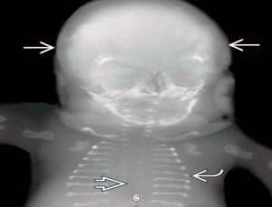 membraneous, ossification, Fetal Skeletal Dysplasias