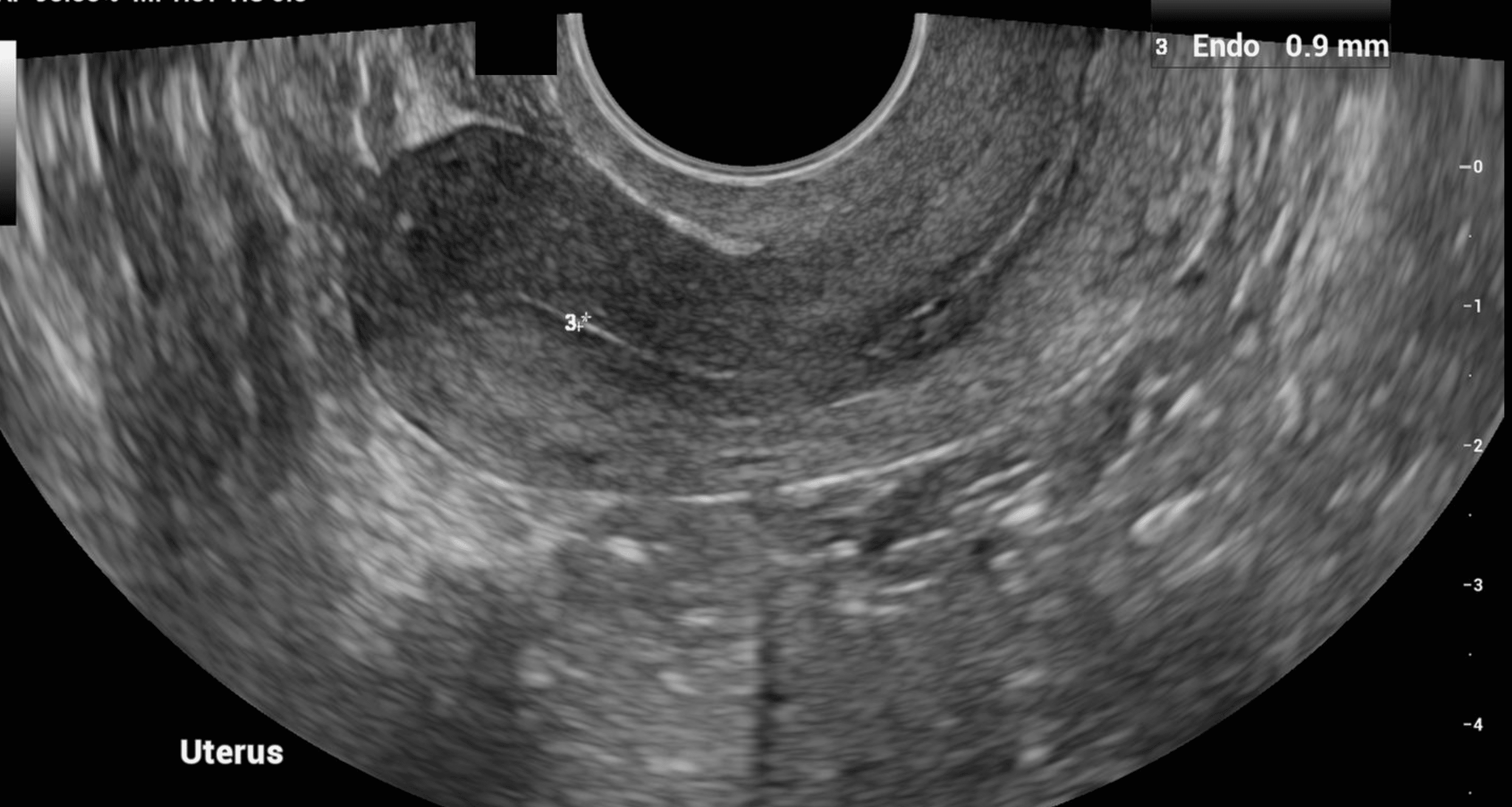 Endometrium, Anatomy, Uterus