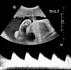 Obstetrics, fetal, Bioeffects of Obstetric Ultrasound, prenatal