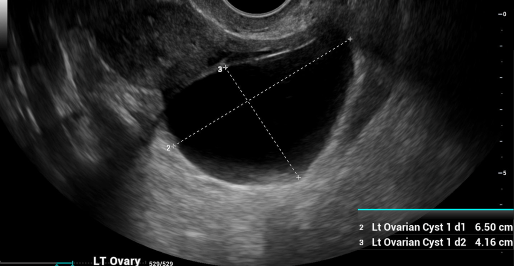 Benign Ovarian Cyst, Ultrasound