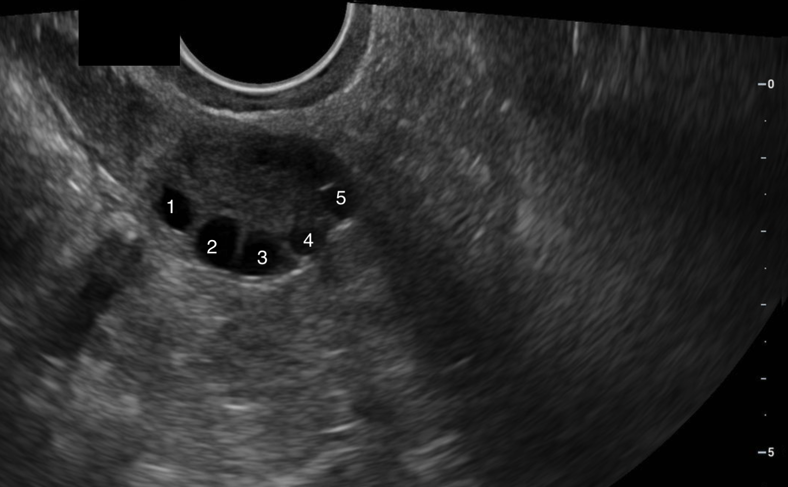 Ovarian Antral, Follicle, Fertility