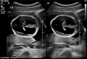 Toxoplasmosis, fetal, sonography, prenatal
