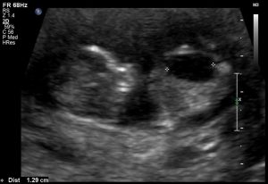 Sonographic Diagnosis of Fetal Uropathy, fetal, prenatal