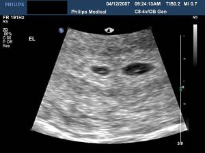 Twin-To-Twin Transfusion Syndrome, sonography, twin pregnancies, fetal