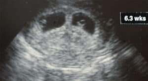 Twin Growth, prenatal, fetal 