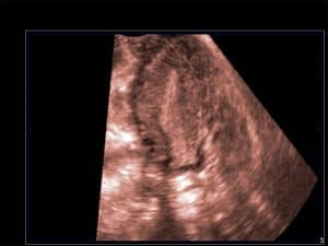 Uterine Anomalies, ultrasound, malformations