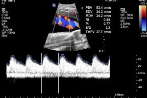 Multi-Vessel Doppler Studies in Intra-Uterine Growth Restriction, prenatal, perinatal, fetal
