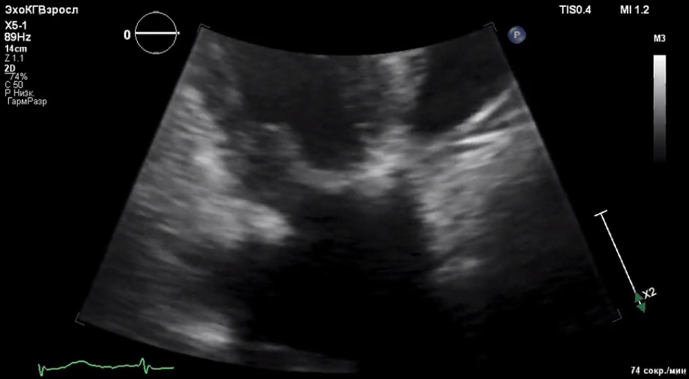 Case Studies in Infective Endocarditis an Update, part 2