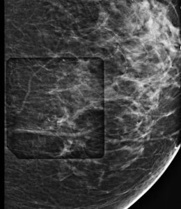 imaging, Stereotactic and Tomosynthesis, breast biopsy