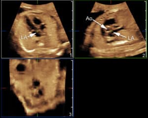 Volumetric Imaging of the Fetal Heart, Heart, Fetal