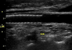 Duplex Ultrasound of Carotid Stents